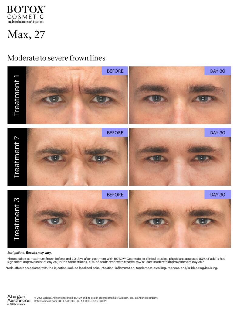 BOTOX® Cosmetic before and after, frown lines (Max, 27)