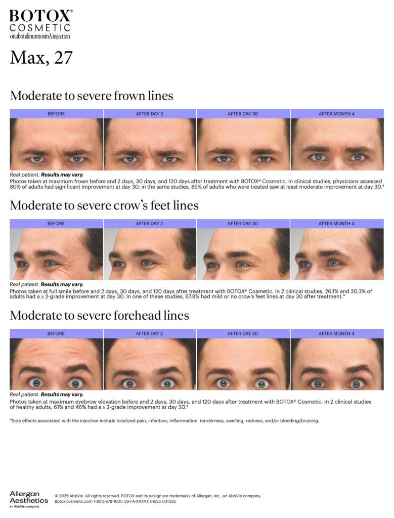 BOTOX® Cosmetic results over time (Max, 27)