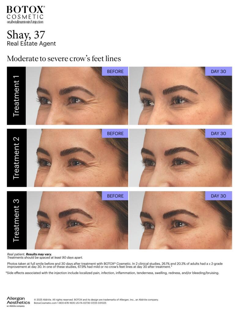 BOTOX® Cosmetic before and after, crow’s feet lines (Shay, 37)