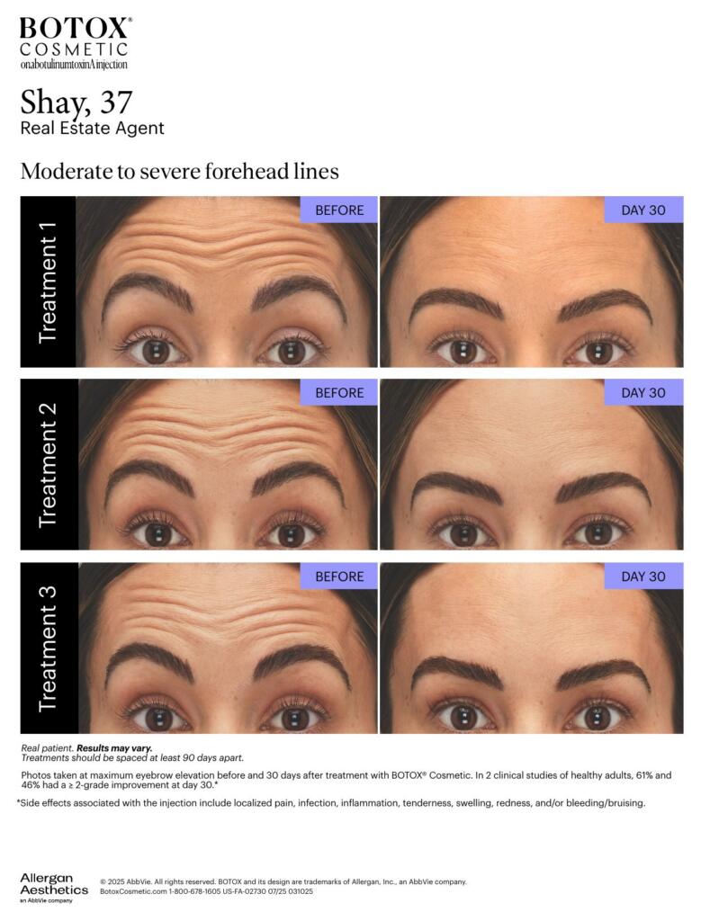 BOTOX® Cosmetic before and after, forehead lines (Shay, 37)