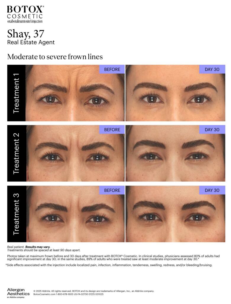 BOTOX® Cosmetic before and after, frown lines (Shay, 37, real patient from Allergan materials)