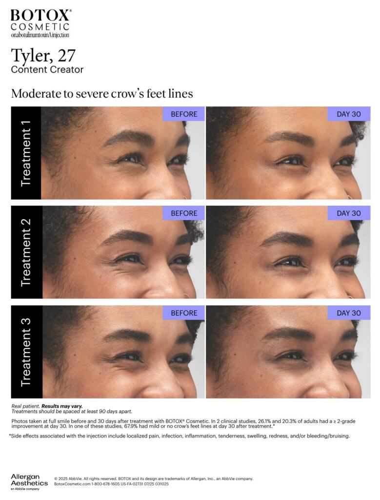 BOTOX® Cosmetic before and after, crow’s feet lines (Tyler, 27)