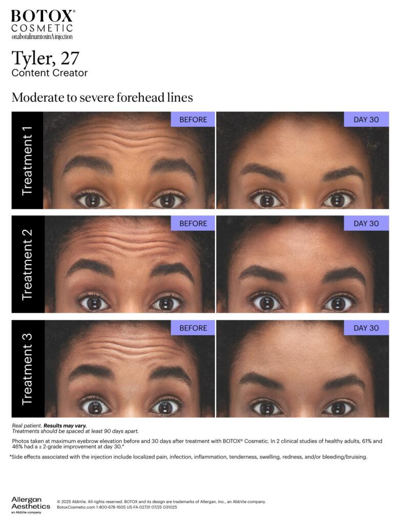 BOTOX® Cosmetic before and after, forehead lines (Tyler, 27)
