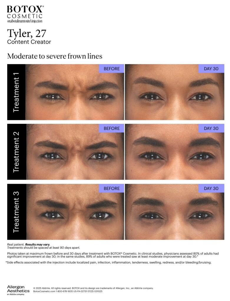 BOTOX® Cosmetic before and after, frown lines (Tyler, 27)