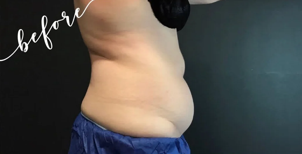 CoolSculpting belly before photo