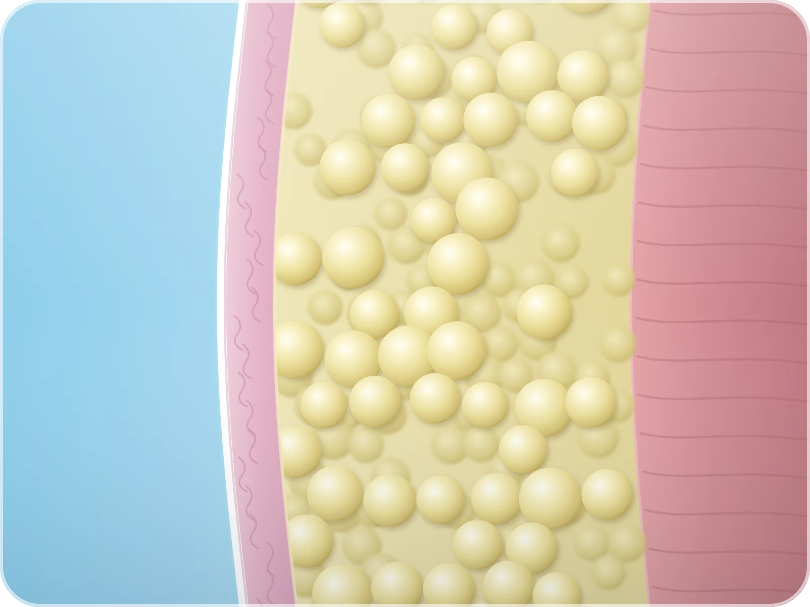 Illustration of a slimmer contour and fewer fat cells after the body clears the treated cells