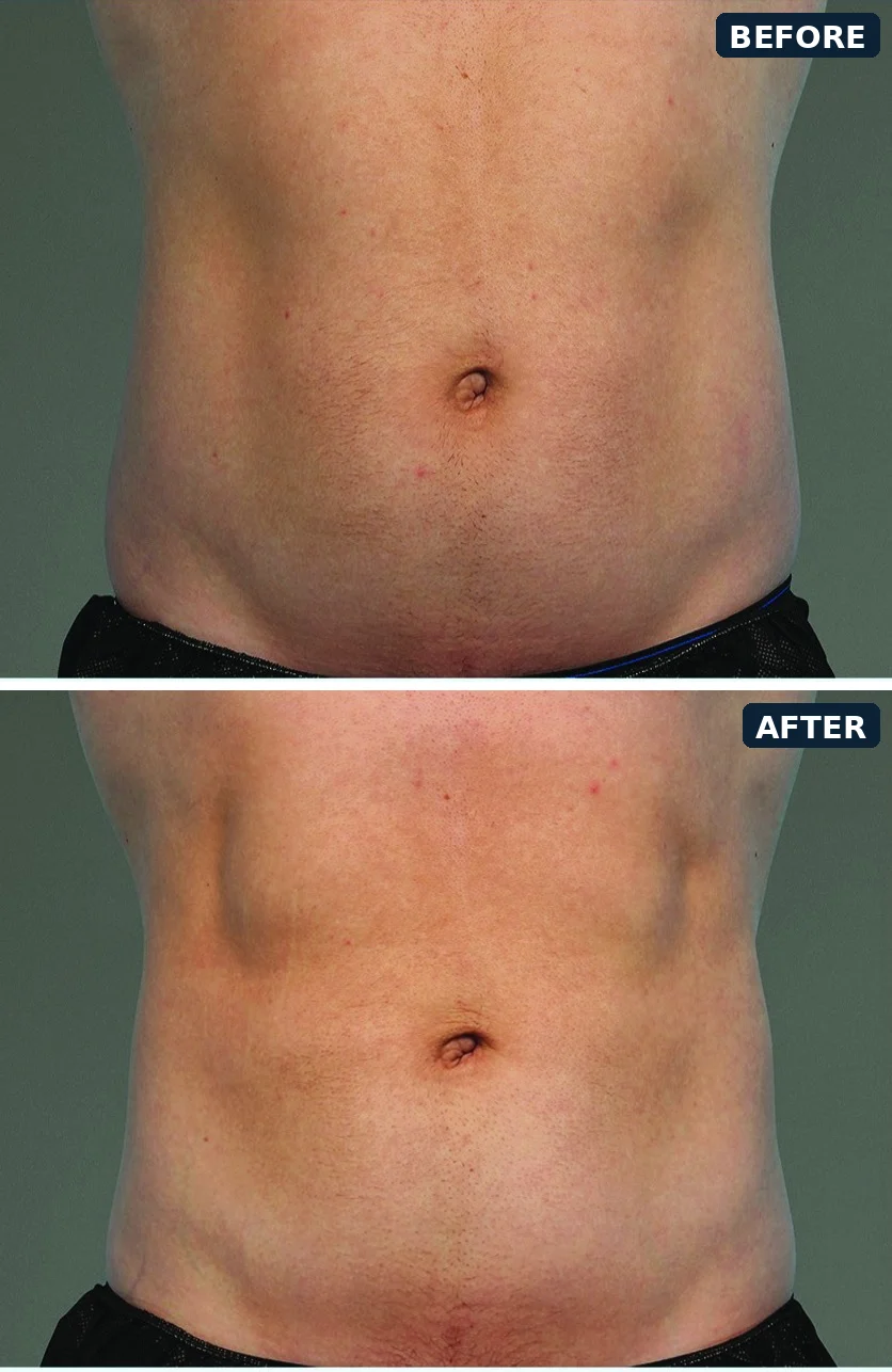 CoolTone abdomen before and after, immediately after 6 treatment visits