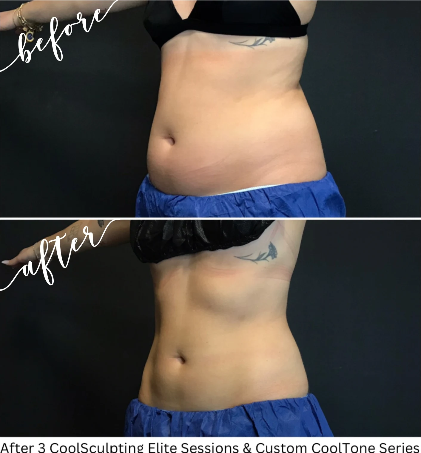 Female client results from CoolSculpting and CoolTone treatments combined on Abdomen