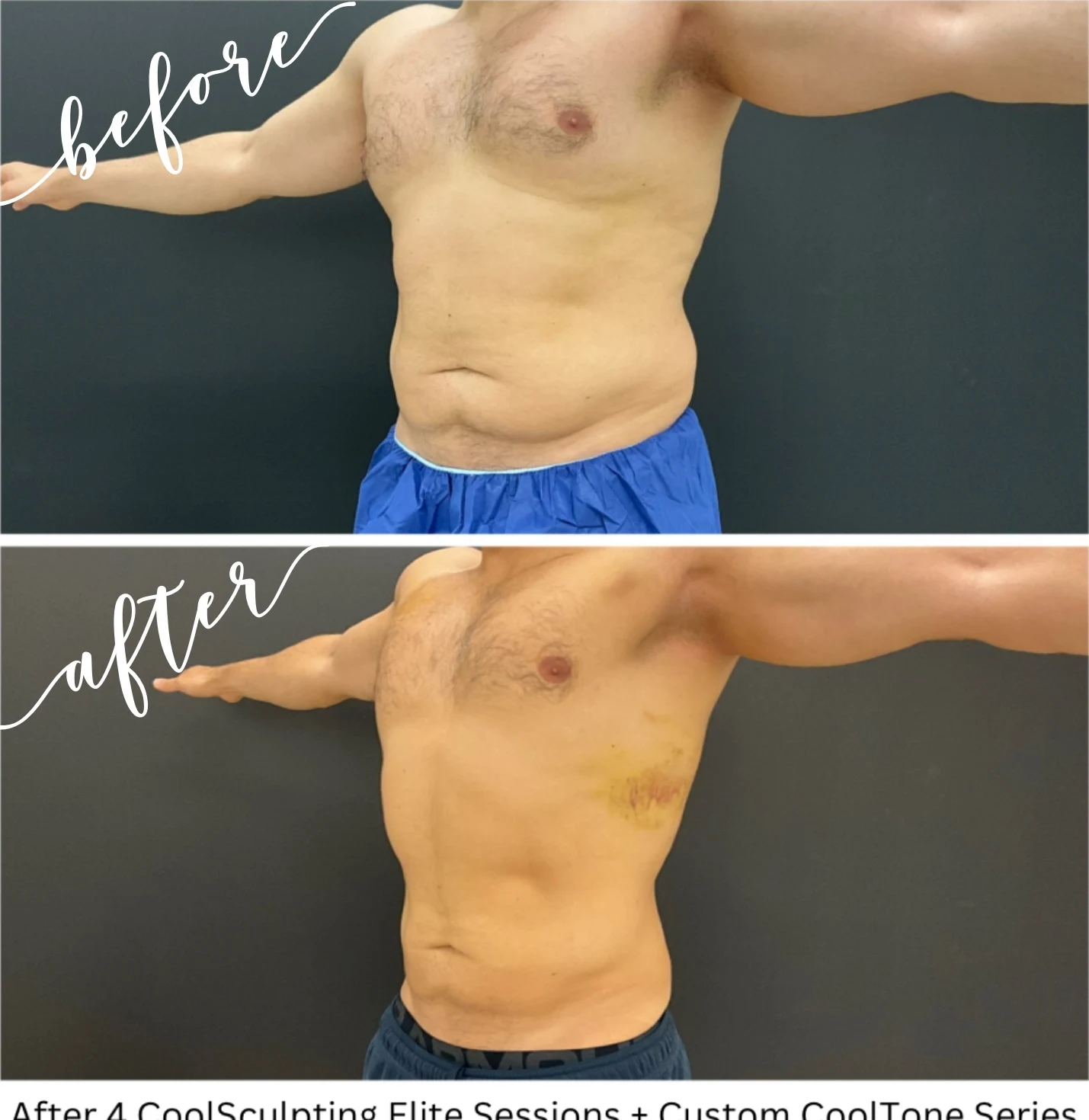 Before and after CoolSculpting Elite and CoolTone treatment showing reduced abdominal fat and improved waistline definition in a male patient.