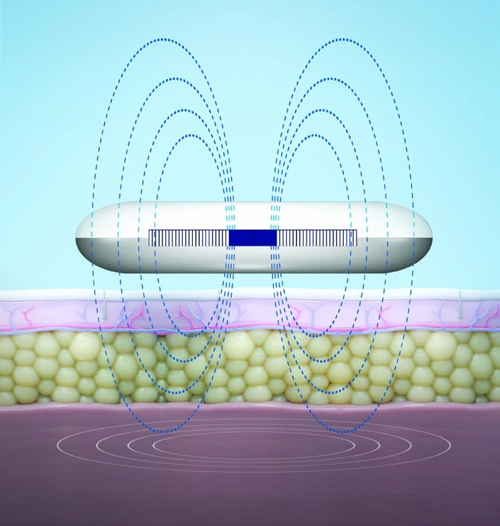 Diagram of CoolTone magnetic muscle stimulation passing through skin and fat to the muscle